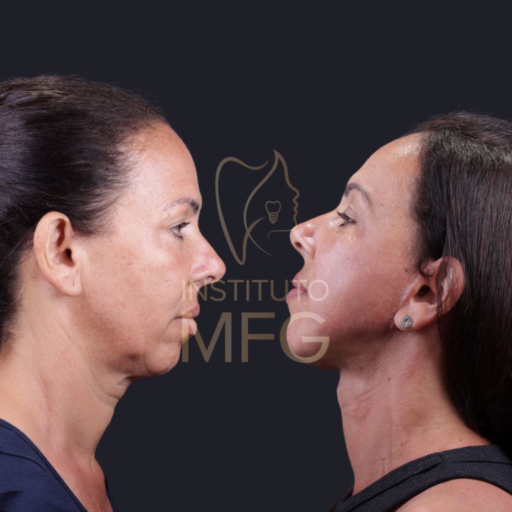 Cervicoplastia