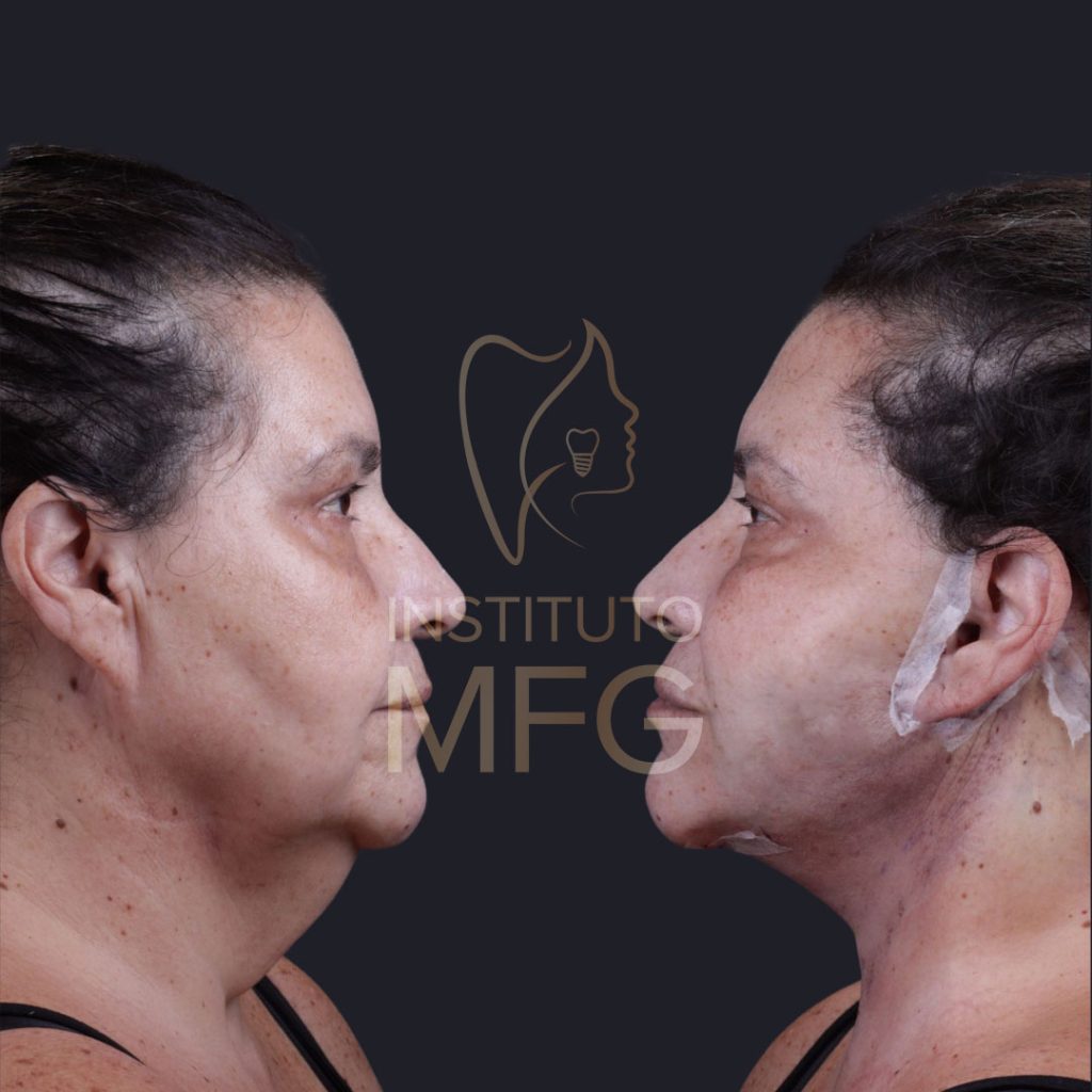 Lifting facial